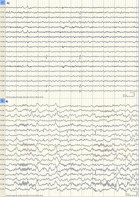 Electroencephalography in Assessment of Autism Spectrum Disorders: A Review